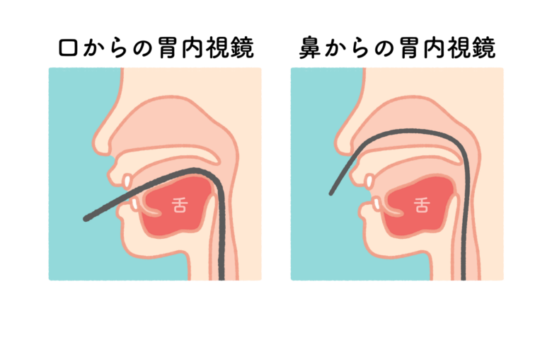経口内視鏡、経鼻内視鏡